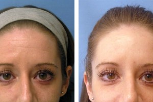 Botox