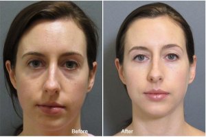Derma Filler