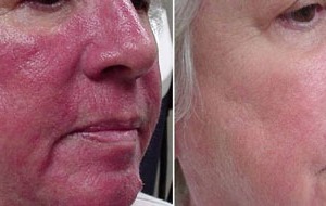 IPL Photofacial