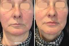 1699555360-lip-filler-2