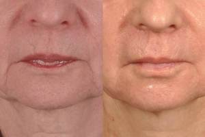 Microneedling