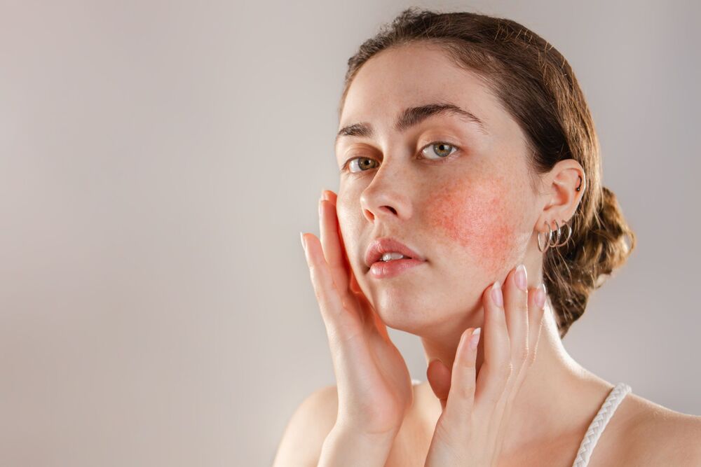 Laser Therapy for Rosacea and Facial Veins – How It Works and What to Expect