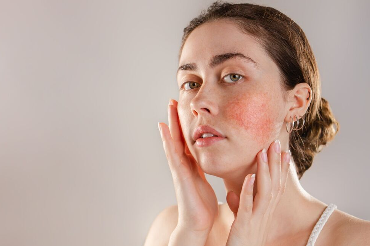 Laser Therapy for Rosacea and Facial Veins – How It Works and What to Expect